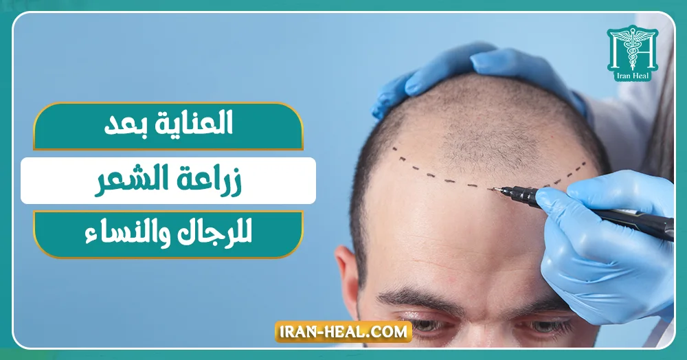 العناية بعد زراعة الشعر للرجال والنساء