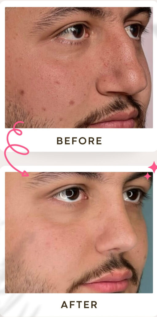 جراحة تجميل الأنف في إيران