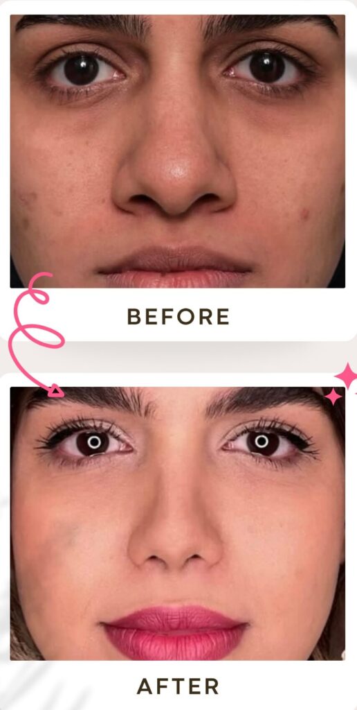 جراحة تجميل الأنف في إيران
