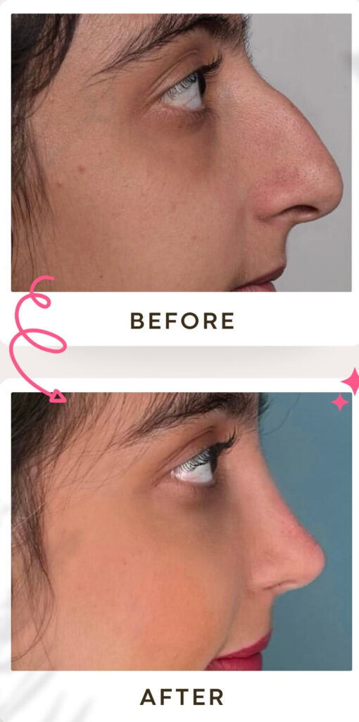 جراحة تجميل الأنف في إيران