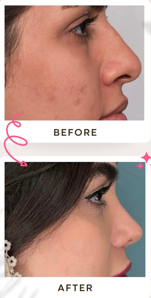 جراحة تجميل الأنف في إيران