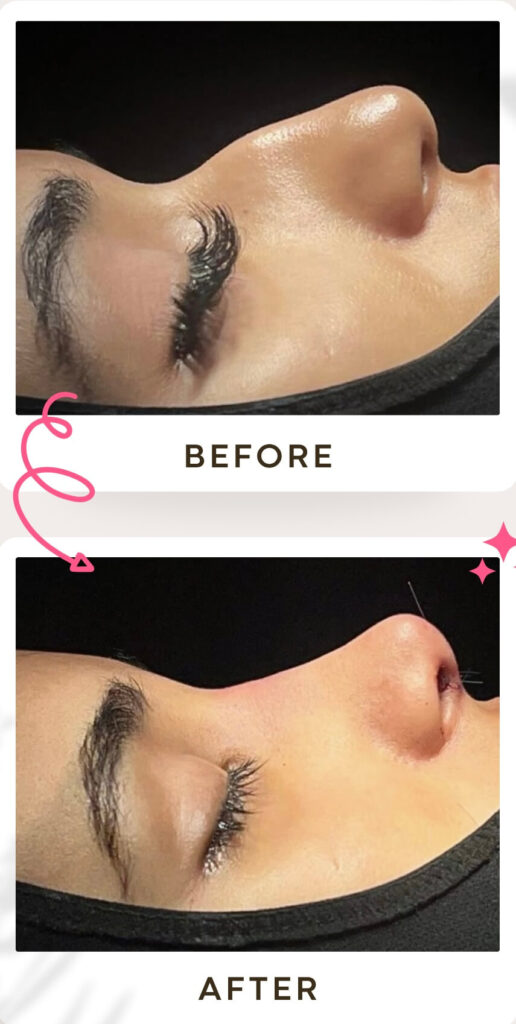 جراحة تجميل الأنف في إيران