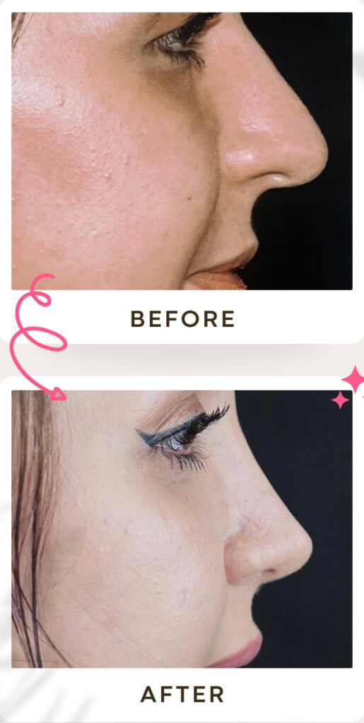 جراحة تجميل الأنف في إيران