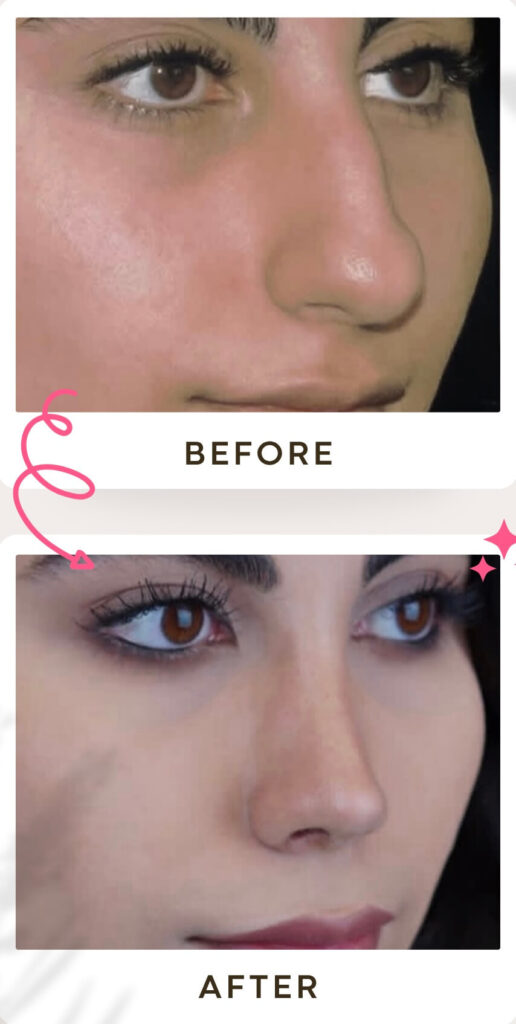 جراحة تجميل الأنف