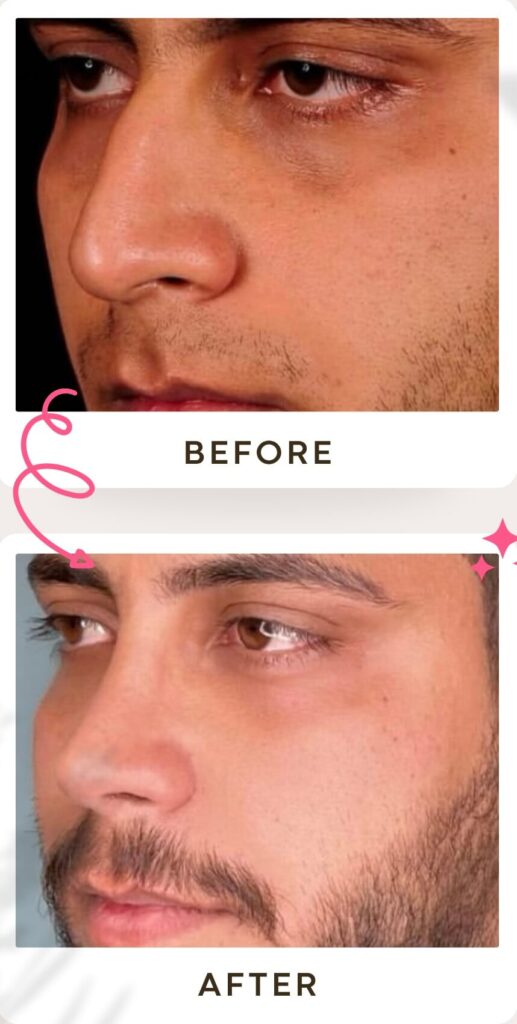جراحة تجميل الأنف في إيران