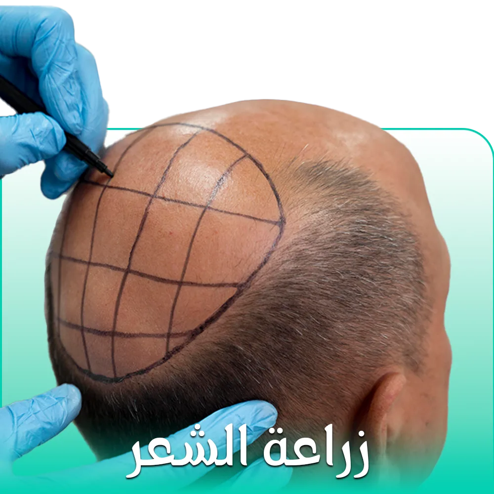 زراعه الشعر