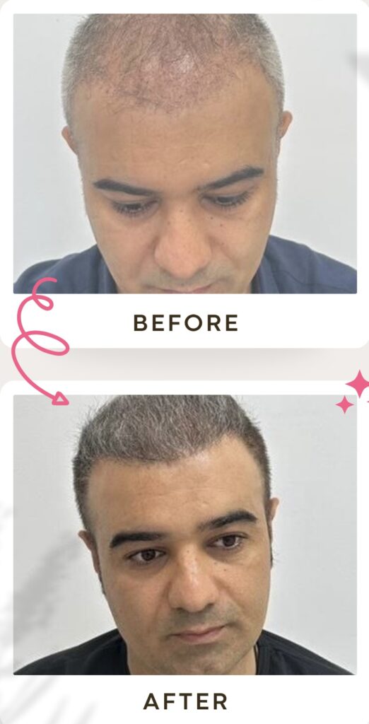زراعة الشعر