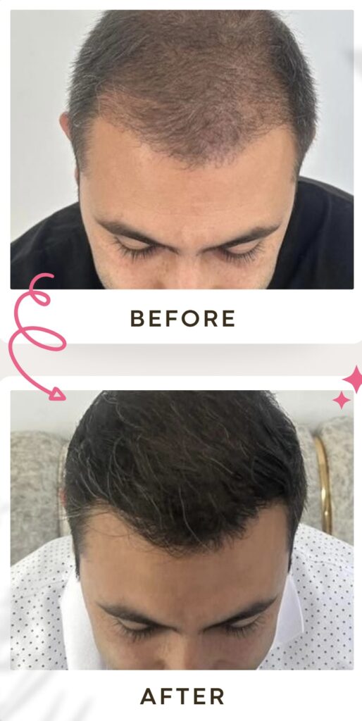 زراعة الشعر