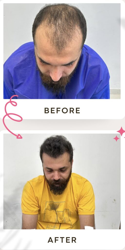زراعة الشعر