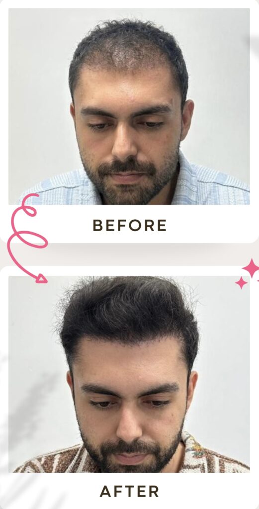زراعة الشعر في ايران