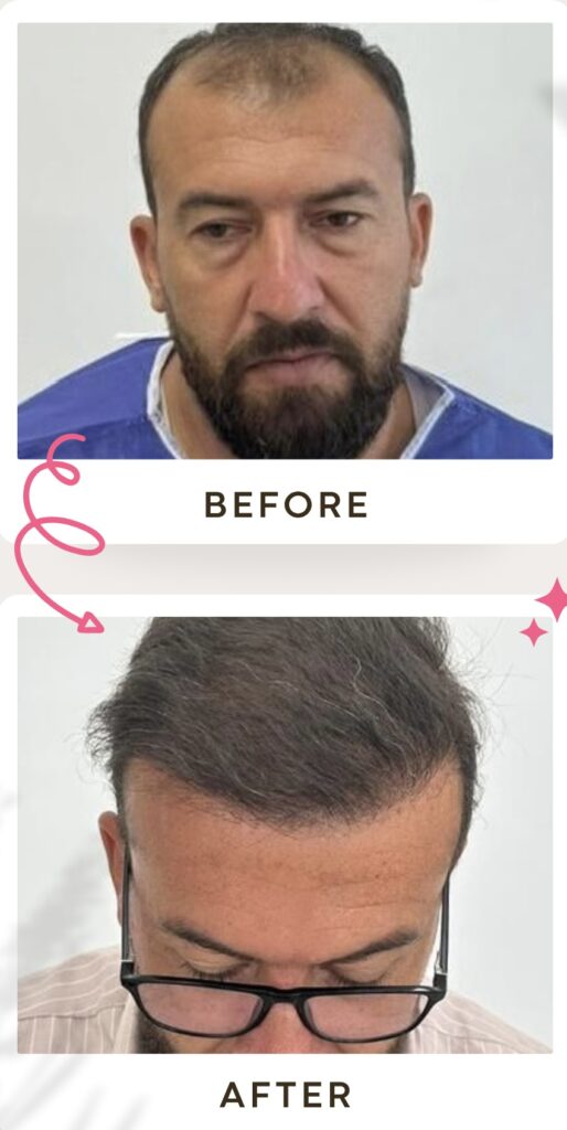 زراعة الشعر