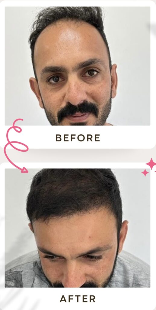 زراعة الشعر في ايران