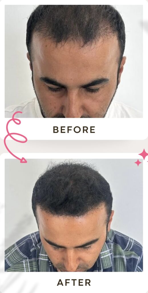 زراعة الشعر في ايران