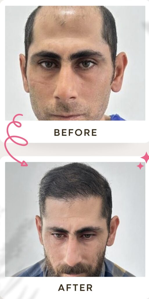 زراعة الشعر في ايران